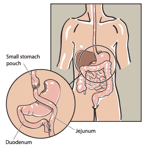A large portion of the stomach is bypassed by a small stomach pouch connected directly to the small intestines.