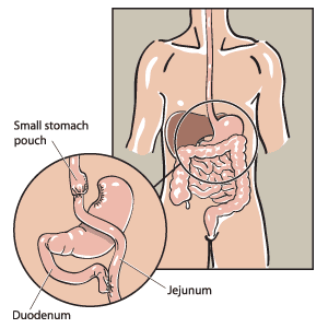 Une grande partie de l'estomac est remplacée par une petite poche gastrique directement reliée à l'intestin grêle. Une grande partie de l'estomac est remplacée par une petite poche gastrique directement reliée à l'intestin grêle.