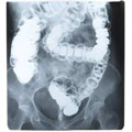 An X-ray image of a colon and rectum following a barium enema.