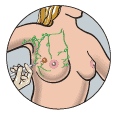 A biopsy (a sample of fluid and tissue) is taken with a needle from a lump in the breast for further investigation.