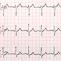 Un exemple d'électrocardiogramme. 