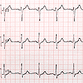 An electrocardiogram produced during an exercise stress test