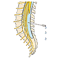 The needle for this spinal tap is inserted into the spine between the vertebrae, allowing cerebrospinal fluid to be collected.