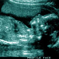 An ultrasound image of a fetus.