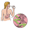 A person performing a H. pylori urea breath test. The inset shows what the H. pylori bacteria look like.