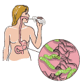 Une personne exécute un test respiratoire à l'urée visant à détecter la présence de la bactérie Helicobacter pylori. L'encart montre à quoi la bactérie H. pylori ressemble.