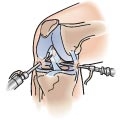 An arthroscope, along with another instrument (another arthroscopic instrument) inserted into the knee joint.