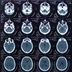 CT scan images of a male skull