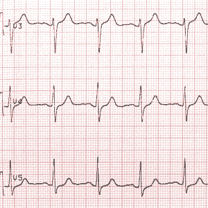 Un &eacute;lectrocardiogramme produit durant un exercice pratiqu&eacute; au cours d'une &eacute;preuve d'effort.