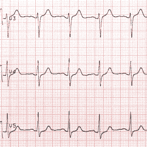 An electrocardiogram produced during an exercise stress test