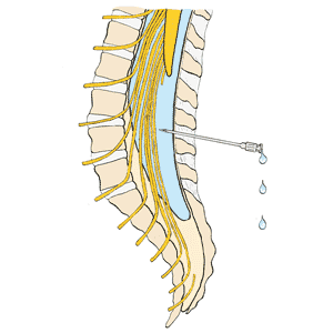 Pour effectuer une ponction lombaire, on introduit l'aiguille dans la colonne vertébrale entre les vertèbres, afin de recueillir le liquide cérébrospinal. Pour effectuer une ponction lombaire, on introduit l'aiguille dans la colonne vertébrale entre les vertèbres, afin de recueillir le liquide cérébrospinal.