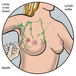 A biopsy (a sample of fluid and tissue) is taken with a needle from a lump in the breast for further investigation.