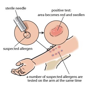 Un test d'allergie cutané. Un test d'allergie cutané.