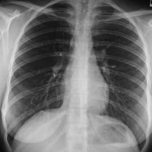 Une radiographie de la poitrine. Une radiographie de la poitrine.