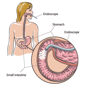 An endoscope shown traveling through the stomach and first part of the small intestines.