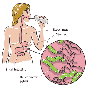 A person performing a H. pylori urea breath test. The inset shows what the H. pylori bacteria look like.