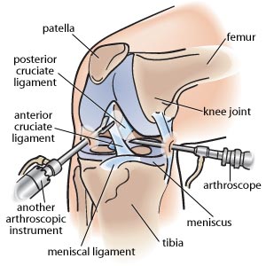 An arthroscope, along with another instrument (another arthroscopic instrument) inserted into the knee joint.