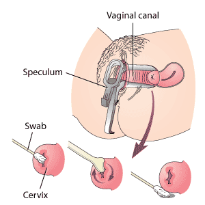 Les cellules du col ut&eacute;rin sont pr&eacute;lev&eacute;es avec un &eacute;couvillon durant un frottis cervicovaginal. Remarquez le sp&eacute;culum, un instrument st&eacute;rile servant &agrave; tenir le vagin ouvert.
