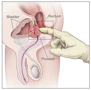 Le médecin introduit un doigt ganté et lubrifié dans le rectum et palpe la prostate pour s'assurer qu'il n'y a rien d'anormal. (Image courtoisie de www.cancer.gov) Le médecin introduit un doigt ganté et lubrifié dans le rectum et palpe la prostate pour s'assurer qu'il n'y a rien d'anormal. (Image courtoisie de www.cancer.gov)