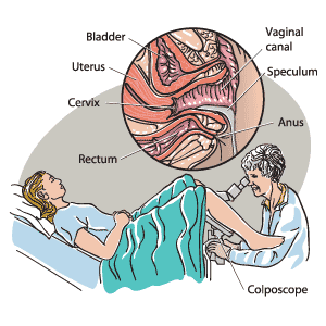 A woman shown having a colposcopy.  The inset shows the speculum opening the vaginal canal to allow a better view of the cervix.     